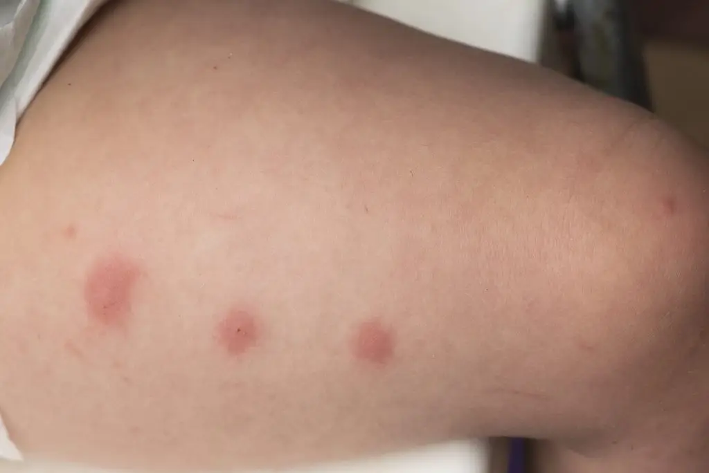 skeeter syndrome